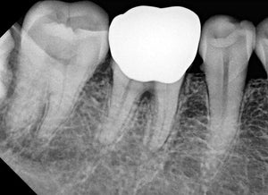 Korea Digital Dental X-Ray  rvg sensor Vatech Ezsensor size 1.5/Vatech Intra-oral X-ray sensor CMOS Digital Dental  X-ray Sensor