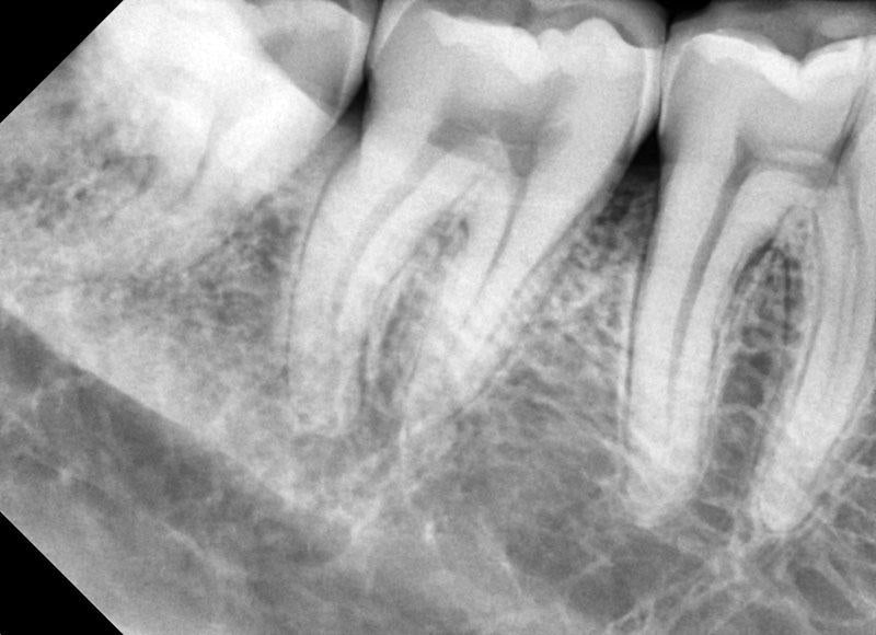 Korea Digital Dental X-Ray  rvg sensor Vatech Ezsensor size 1.5/Vatech Intra-oral X-ray sensor CMOS Digital Dental  X-ray Sensor